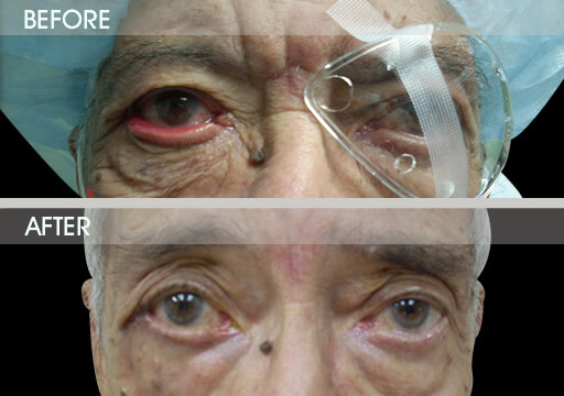 Ectropion Repair Before And After