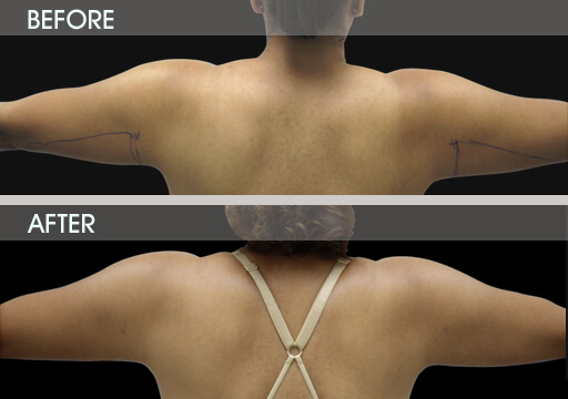 Arm Liposuction Before And After Back View
