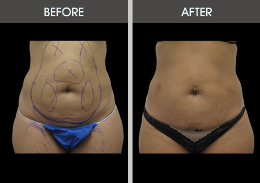 Abdominal Liposuction Before And After Front View