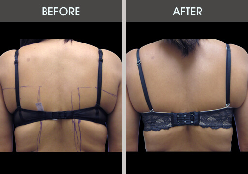 Bra Bulge Liposuction Before And After