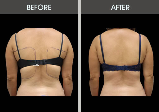 Bra Bulge Liposuction Before And After Back View