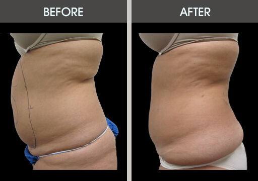Liposuction Before And After Left Side View