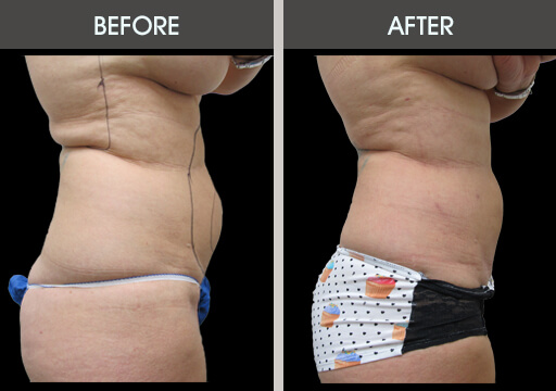 Lipo Before And After Right Side View