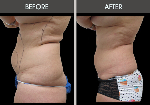 Lipo Before And After Left Side View