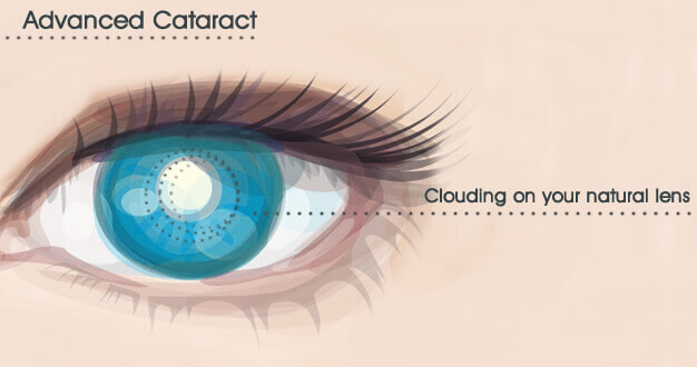 Advanced Cataract Surgery