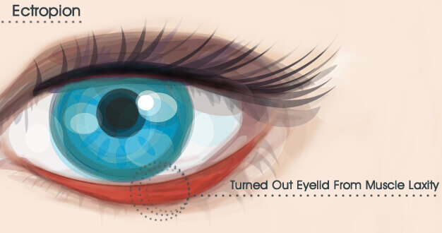 Ectropion Treatment