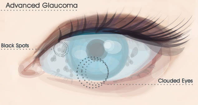 Advanced Glaucoma Treatments