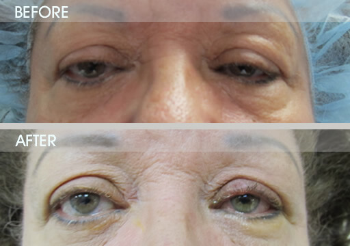 Ptosis Surgery Before And After