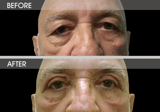 Blepharoplasty Before And After