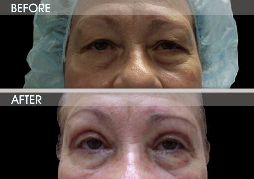 Blepharoplasty Surgery Before And After