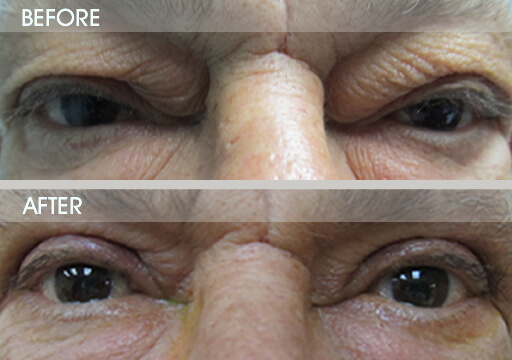 Eyelid Surgery Before And After