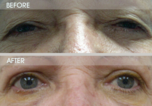 Upper Eyelid Surgery Before And After