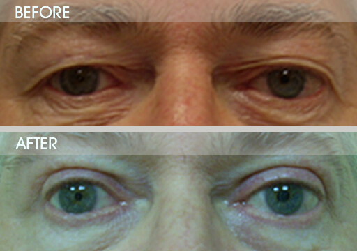 Upper Blepharoplasty Before And After