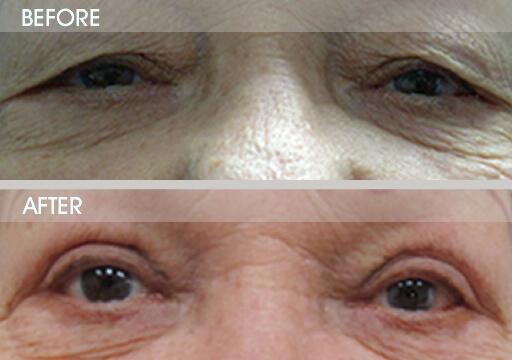 Blepharoplasty Results