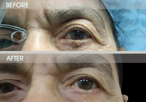 Eyelid Tumor Treatment Before And After