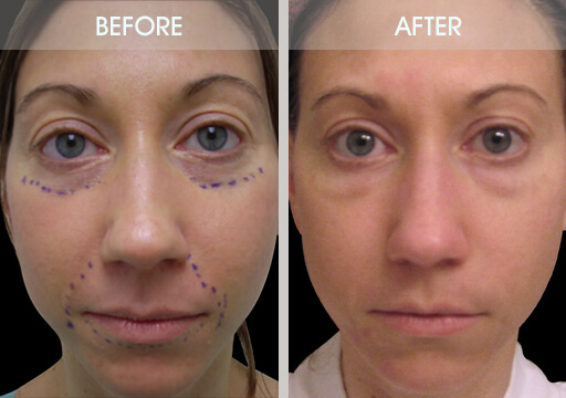 Fat Transfer Before And After