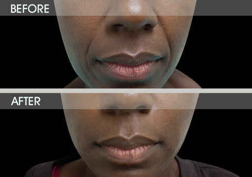 NATURALFILL® Injections Before And After