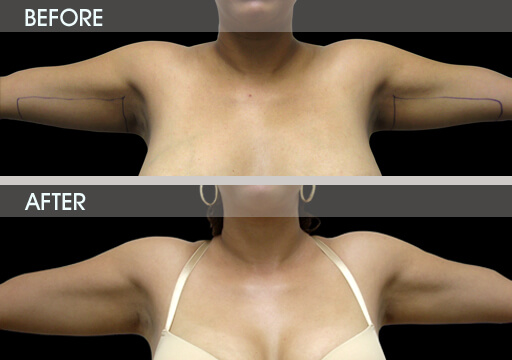Arm Liposuction Before And After Front View