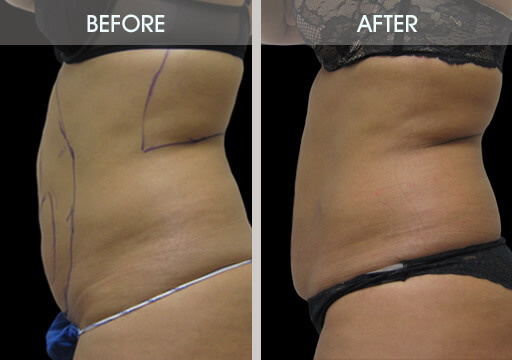 Abdominal Liposuction Before And After Left Side View