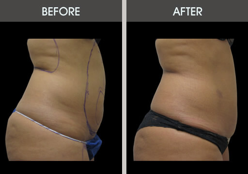 Abdominal Liposuction Before And After Right Side View