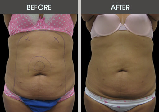 Abdominal Lipo Before And After Front View