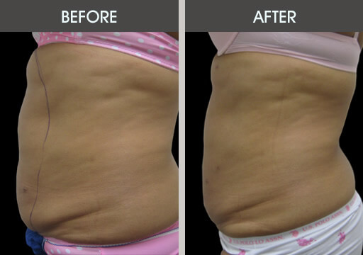 Abdominal Lipo Before And After Left Side View