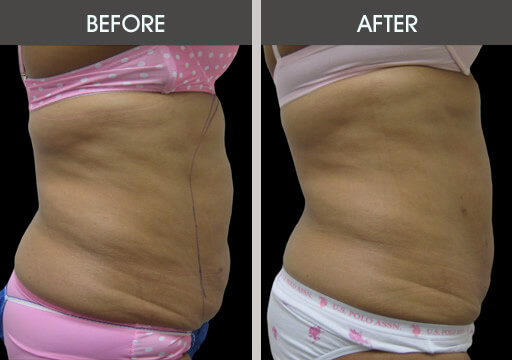 Abdominal Lipo Before And After Right Side View