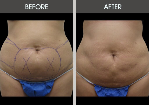 Liposuction Before And After