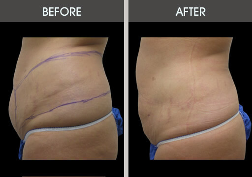 Liposuction Surgery Before And After