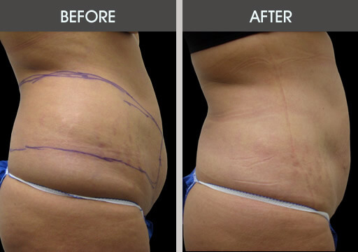 Lipo Surgery Before And After