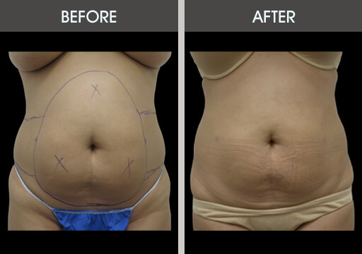 Lipo Before And After