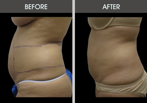 Liposuction Surgery Before And After
