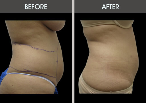Abdominal Liposuction Before And After
