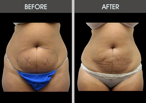 Liposuction Before and After