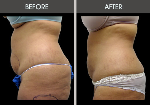 Abdominal Liposuction Surgery Before And After