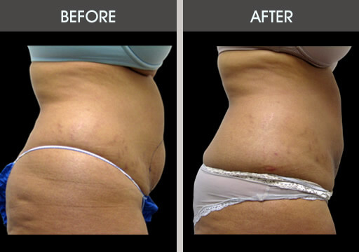Abdominal Lipo Surgery Before And After