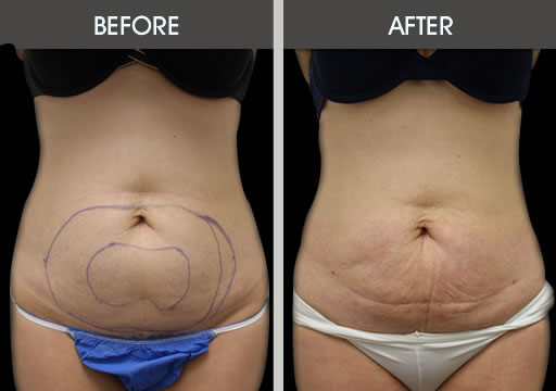 Stomach Lipo Before And After