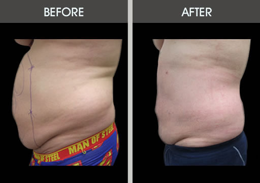 Male Liposuction Before And After
