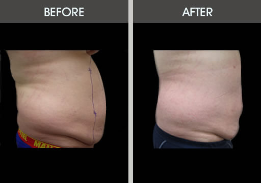 Liposuction Before and After | Stomach Liposuction