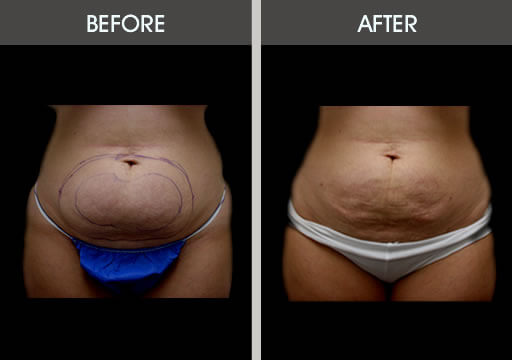 Stomach Lipo Before And After Front View