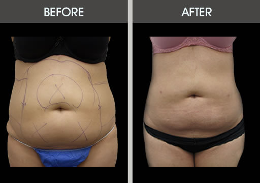 Stomach Liposuction Before And After