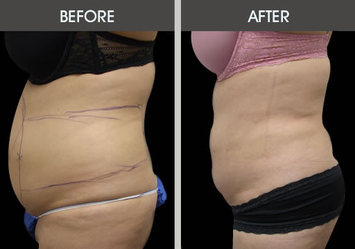 Stomach Liposuction Surgery Before And After