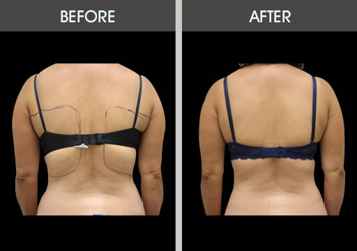 Smartlipo of the Back - Flanks, Bra Rolls, and Neck Humps - Explore Plastic  Surgery