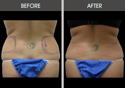 Liposuction Love Handles