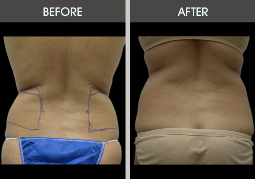 Liposuction for Love Handles