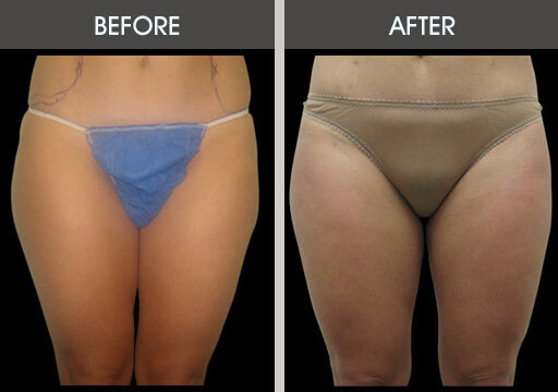 Thigh Lipo Before And After
