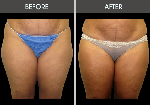 Thigh Lipo Before And After Front View