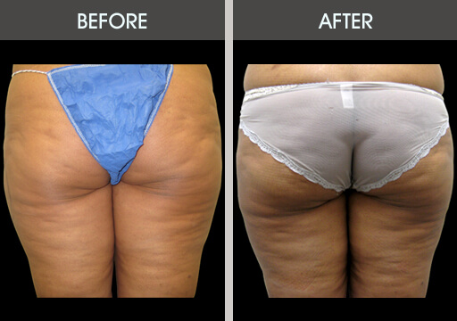 Thigh Lipo Before And After Back View