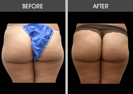 Thigh Liposuction Before And After