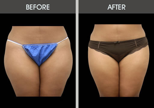 Thigh Liposuction Before And After Front View